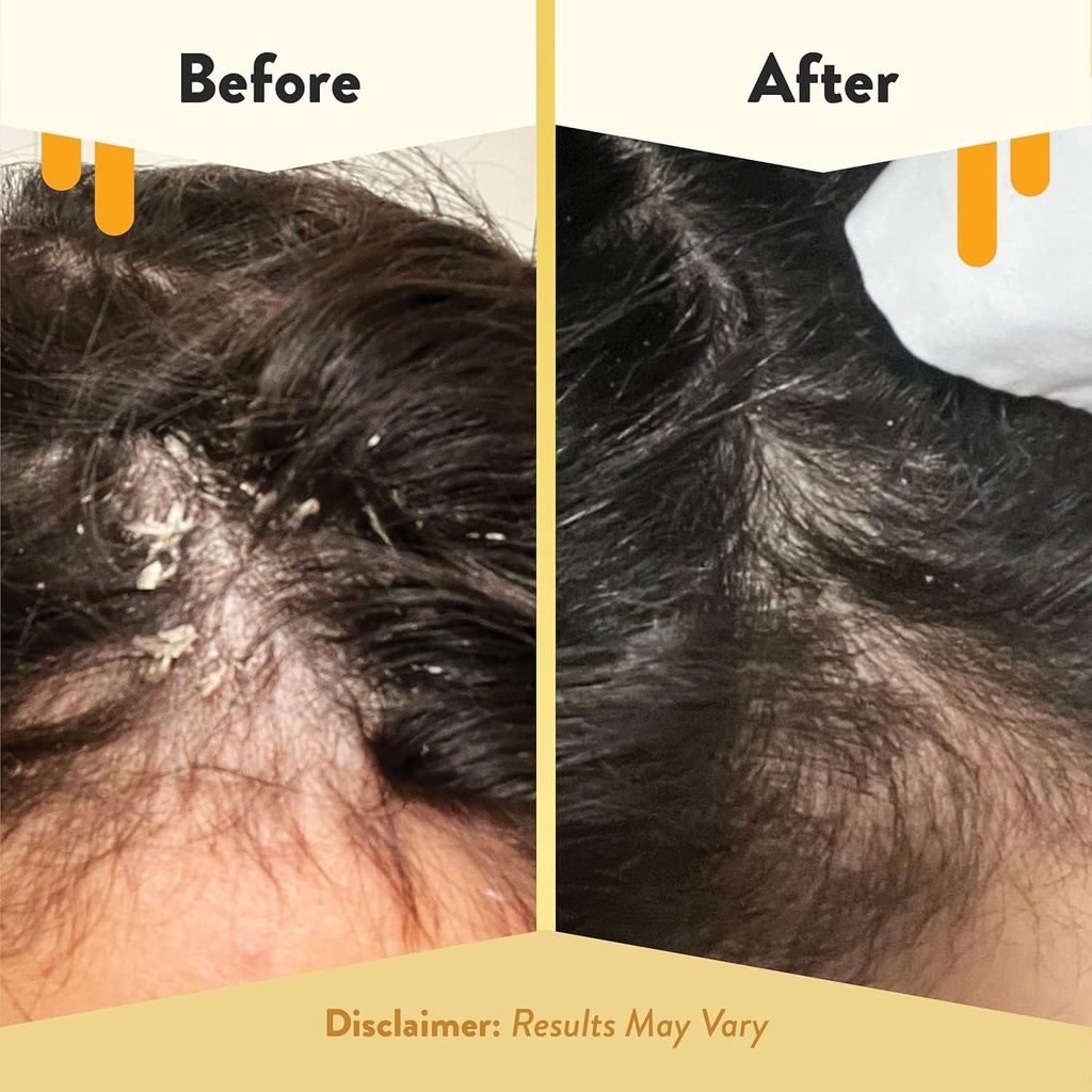 eczema-honey-soothing-scalp-oil---natura-4.jpg