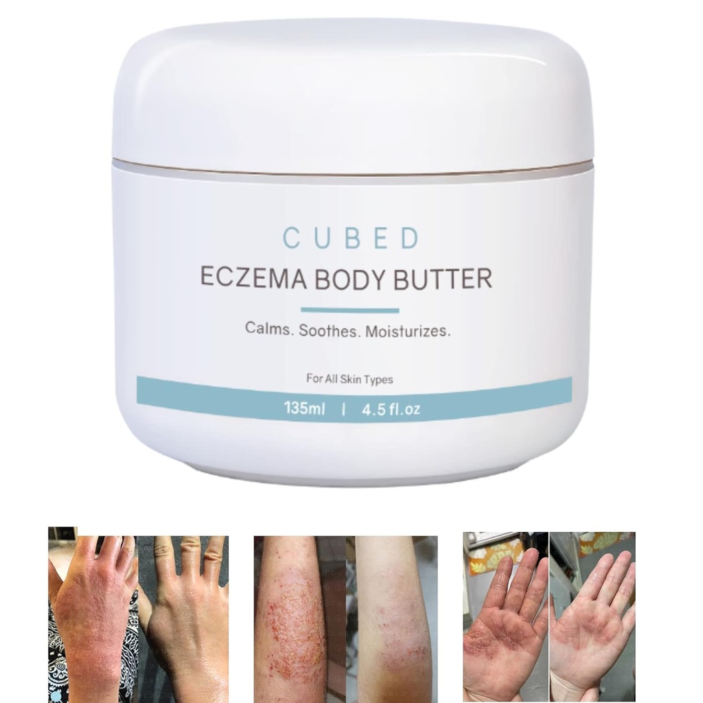 성인을 위한 입방체 4.5 oz Eczema 크림, Eczema 처리, 습기를 공급 건조한 Irridated 피부, 화제 스테로이드 철회 증상을 위한 똑똑한 로션, Psoriasis & Rosacea, Eczema, Dermatitis